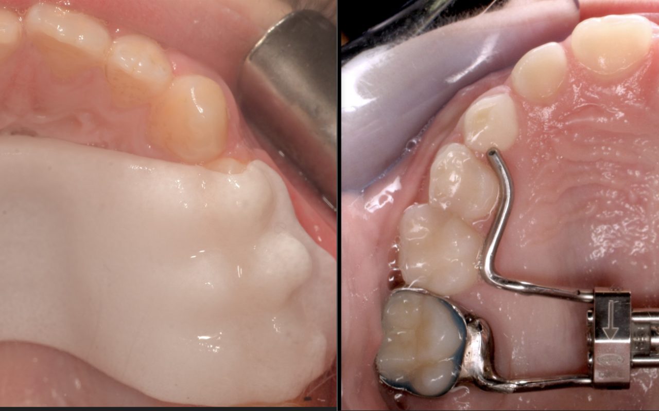 διεύρυνση της άνω γνάθου με invisalign Palatal Expander (IPE) ή Rapid Palatal Expander (RPE)