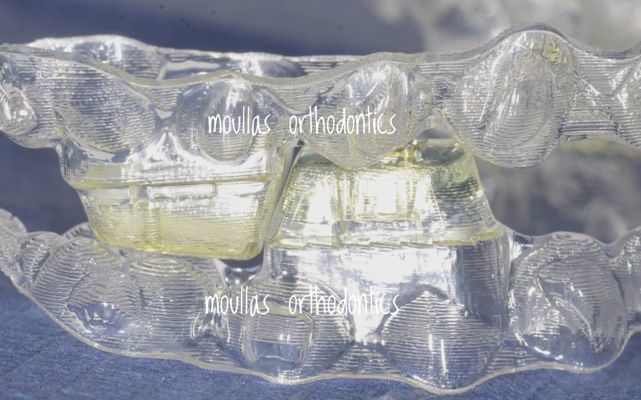 Invisalign Teen with occlusal blocks, ορθοδοντικός Μούλλας